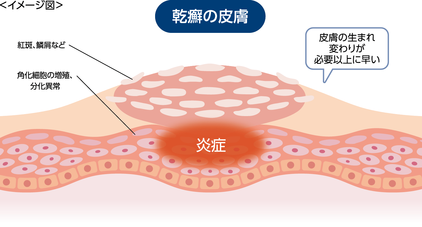 乾癬とは